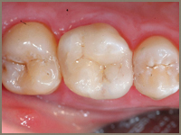 cerec Masek_after.jpg